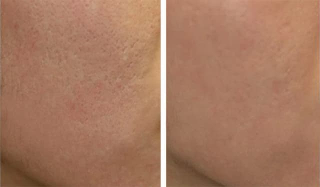 Peeling węglowy co daje? Efekty, korzyści i przeciwwskazania dla zdrowej skóry Peeling węglowy co daje? Efekty, korzyści i przeciwwskazania dla zdrowej skóry